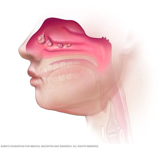 Sinuses Treatment